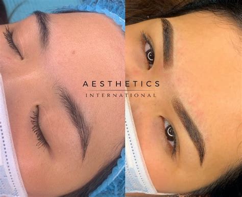 microblading in the philippines|Scalp Micropigmentation Manila, Philippines.